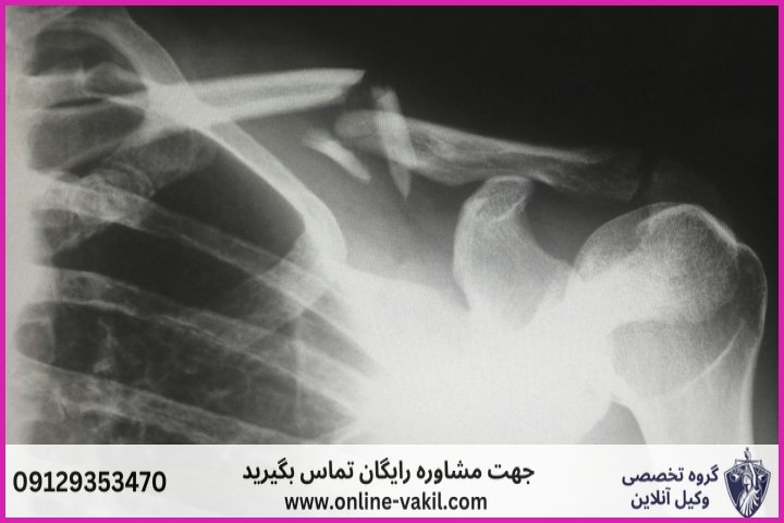 میزان دیه شکستگی استخوان در اعضای مختلف بدن